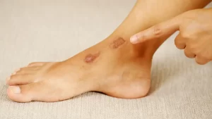 luka di kaki
